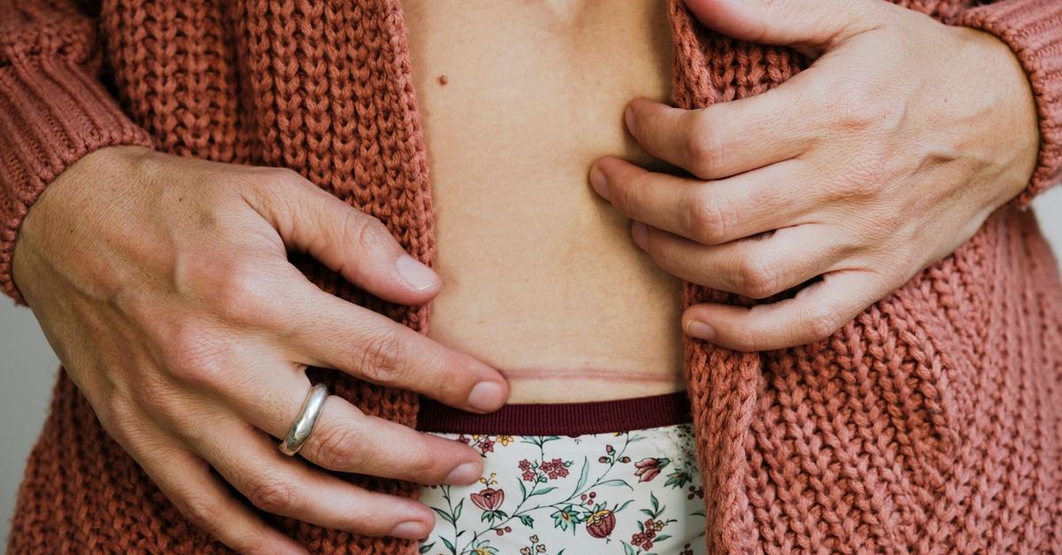 Worauf-es-bei-der-Pflege-von-Narben-ankommt