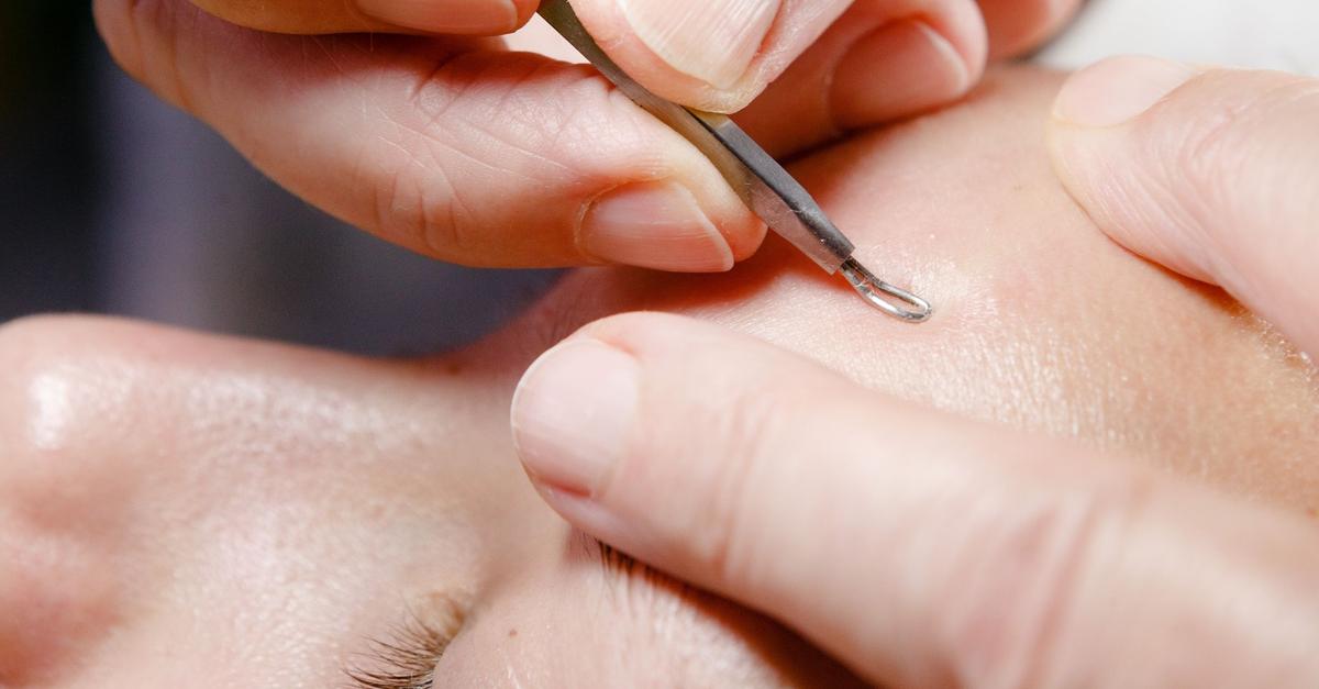 Finger-weg-Wie-Pickel-entstehen-und-gut-wieder-abheilen